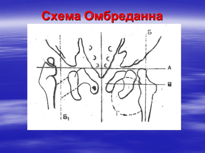 Схема Омбреданна